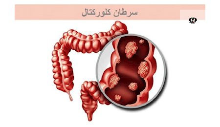 اجرای طرح مطالعه تأثیر متامفتامین بر ژن&zwnj;های دخیل در سرطان کلورکتال