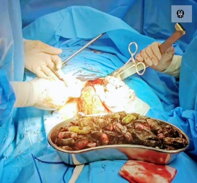 خارج کردن ۹۰ بسته مواد مخدر از معده یک فرد در کرج